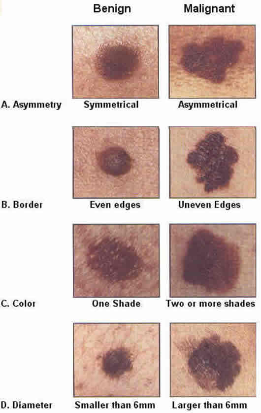 Pictures of UV Cancerous Moles