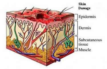 Sunburn Only Affects the Top Layer of the Skin.